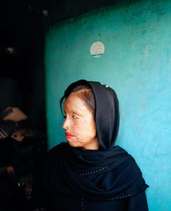 パキスタンのカラチで、顔に酸をかけられた女性。最新の研究によって、このような暴力行為は異常気象に伴って増加することが指摘された。